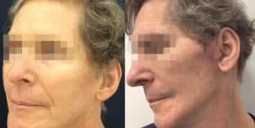 facelift colombia 362 - 2-min