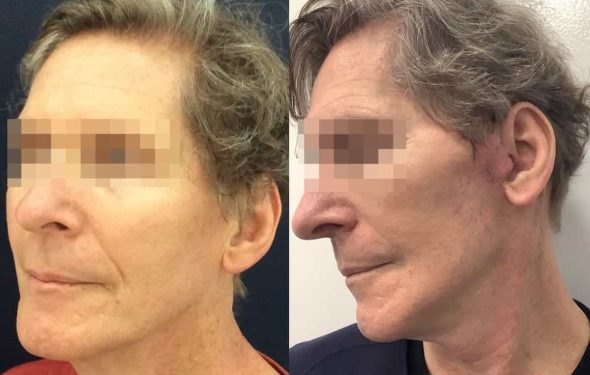 facelift colombia 362 - 2-min