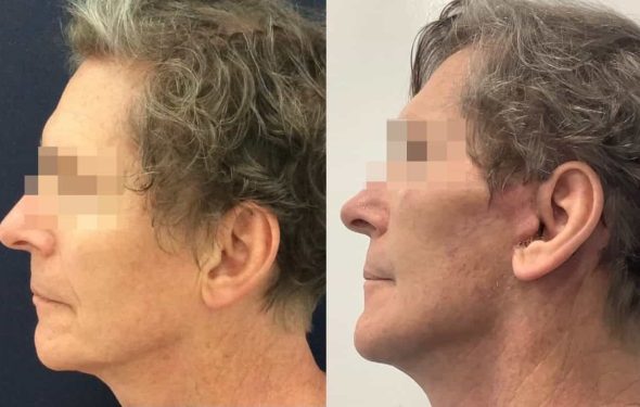 facelift colombia 362 - 3-min