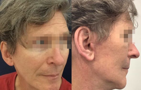 facelift colombia 362 - 4-min