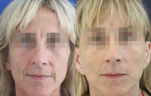 facelift colombia 366 - 1-min