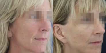 facelift colombia 366 - 2-min