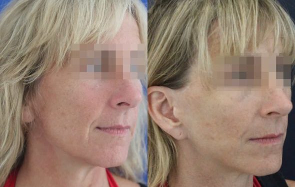 facelift colombia 366 - 2-min