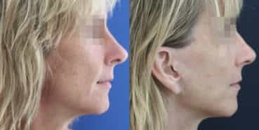facelift colombia 366 - 3-min
