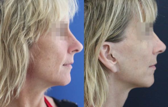 facelift colombia 366 - 3-min