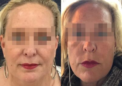 facial fat grafting colombia 106 - 1-min