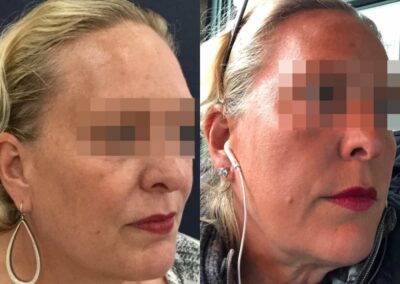 facial fat grafting colombia 106 - 2-min