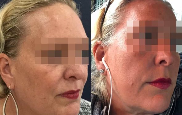 facial fat grafting colombia 106 - 2-min