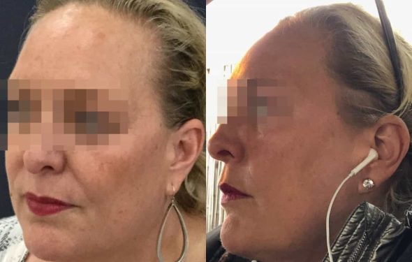 facial fat grafting colombia 106 - 3-min