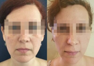 facial fat grafting colombia 217 - 1-min