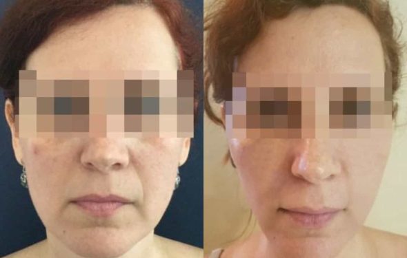 facial fat grafting colombia 217 - 1-min