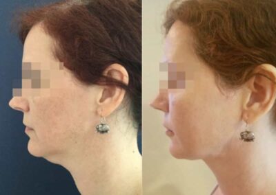 facial fat grafting colombia 217 - 2-min