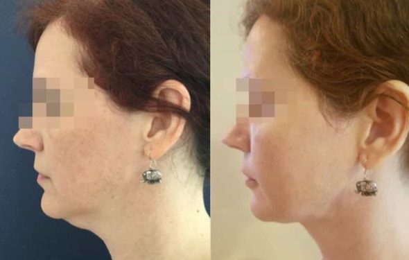 facial fat grafting colombia 217 - 2-min