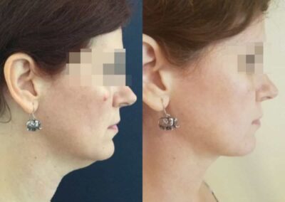 facial fat grafting colombia 217 - 3-min