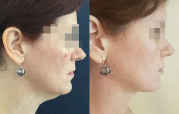 facial fat grafting colombia 217 - 3-min