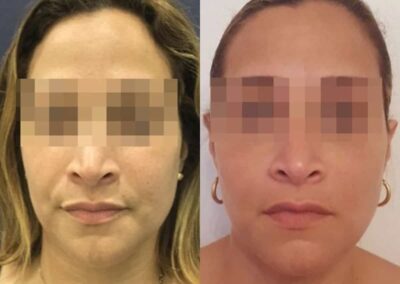 facial fat grafting colombia 286 - 1-min