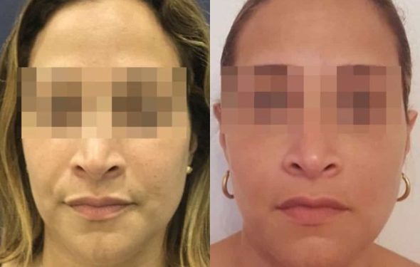 facial fat grafting colombia 286 - 1-min