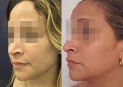 facial fat grafting colombia 286 - 2-min
