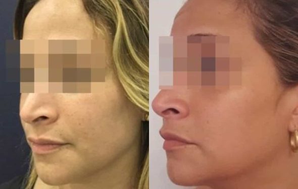 facial fat grafting colombia 286 - 2-min