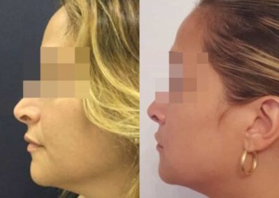 facial fat grafting colombia 286 - 3-min