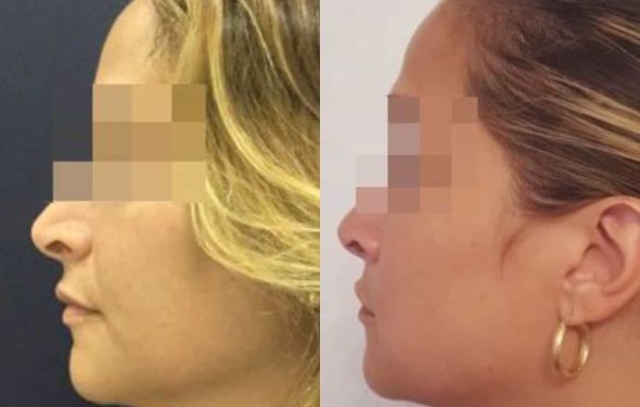 facial fat grafting colombia 286 - 3-min
