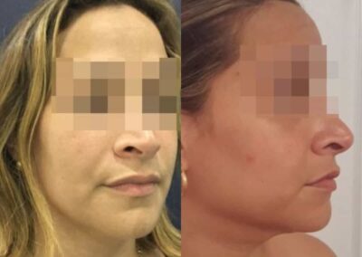 facial fat grafting colombia 286 - 4-min