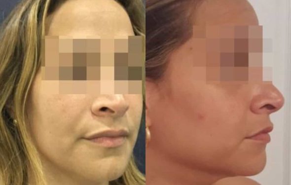 facial fat grafting colombia 286 - 4-min