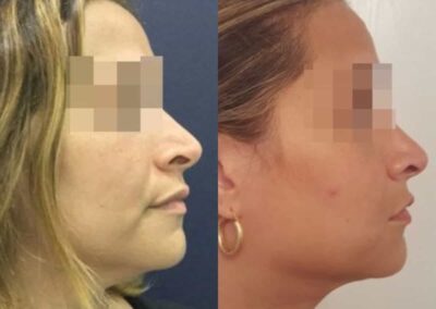 facial fat grafting colombia 286 - 5-min