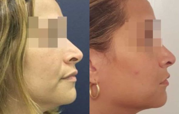facial fat grafting colombia 286 - 5-min