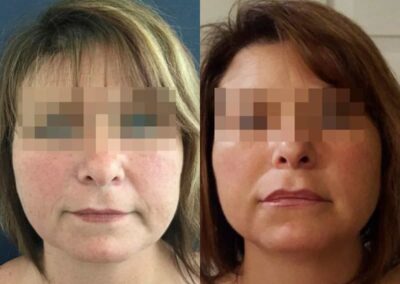 facial fat grafting colombia 294 - 1-min