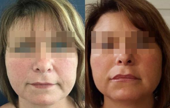 facial fat grafting colombia 294 - 1-min