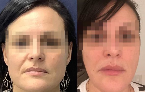 facial fat grafting colombia 317 - 1-min