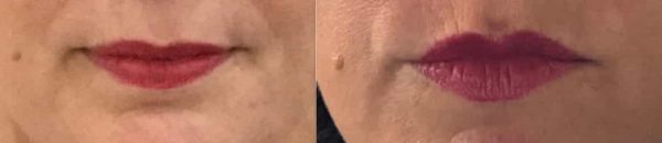 before and after lip procedure showing enhanced lip definition and color correction at premium care plastic surgery