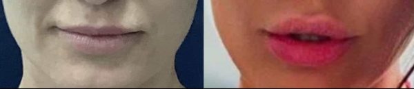 before and after lip enhancement showing improved fullness and symmetry from a procedure at premium care plastic surgery