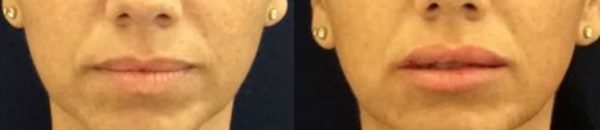 results of a lip augmentation treatment at premium care plastic surgery