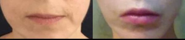 before and after lip augmentation procedure at premium care plastic surgery