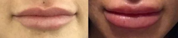 before and after lip enhancement procedure at premium care plastic surgery