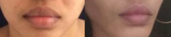 before and after lip filler treatment at premium care plastic surgery