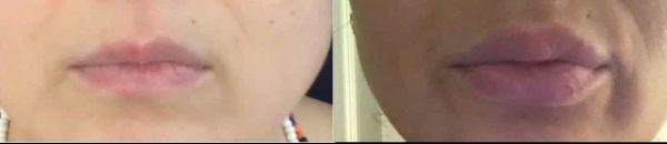 lip augmentation before and after results showing natural enhancement of lip volume and shape from premium care plastic surgery