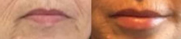 before and after lip enhancement treatment at premium care plastic surgery