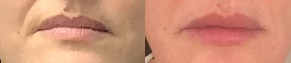 lip enhancement before and after treatment at premium care plastic surgery