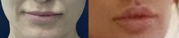 lip augmentation before and after at premium care plastic surgery