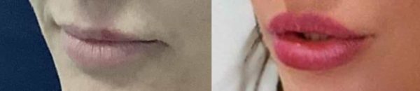 before and after comparison of lip enhancement showing fuller, more defined lips at premium care plastic surgery
