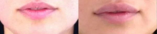 unique lip enhancement before and after results at premium care plastic surgery