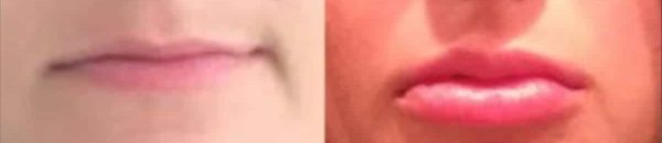 before and after lip augmentation procedure at premium care plastic surgery