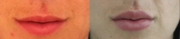lip augmentation results before and after at premium care plastic surgery
