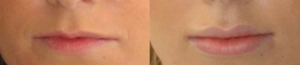before and after results of lip augmentation treatment at premium care plastic surgery
