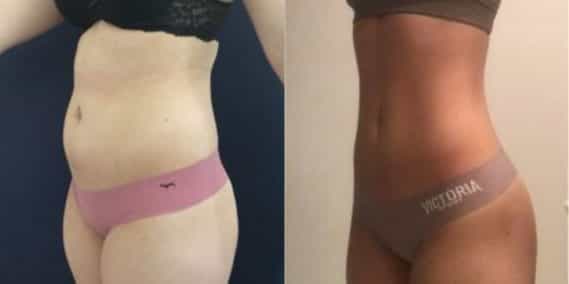 liposuction colombia 105 - 2-min