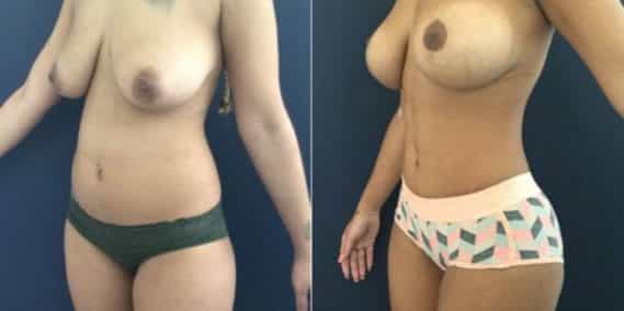 liposuction colombia 207 - 2-min
