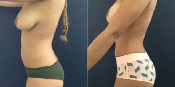 liposuction colombia 207 - 3-min